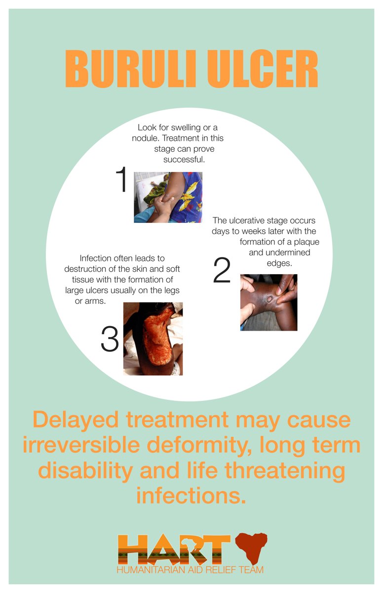 HART Buruli ulcer education card showing the three stages of progression